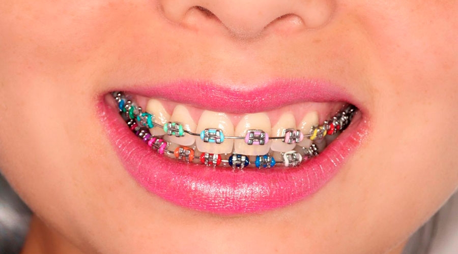 erros comuns ao usar aparelho ortodôntico