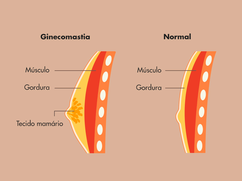 cirurgia de ginecomastia pelo sus