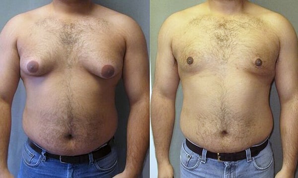 Ginecomastia: Entenda a Diferença entre a Verdadeira e a Pseudoginecomastia