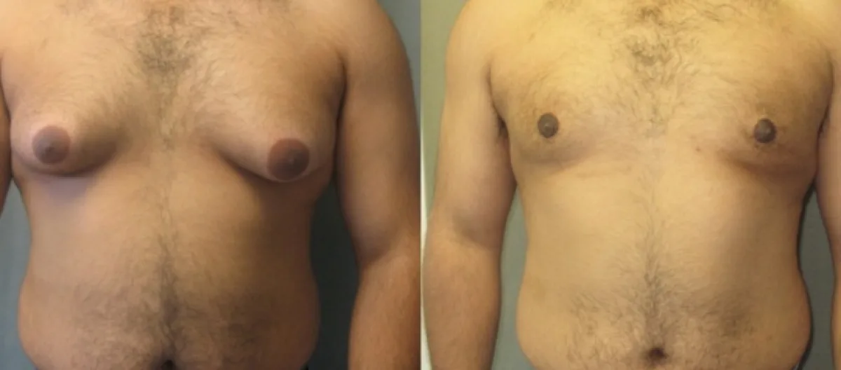 Preparação para a Cirurgia de Ginecomastia: Exames e Cuidados Essenciais