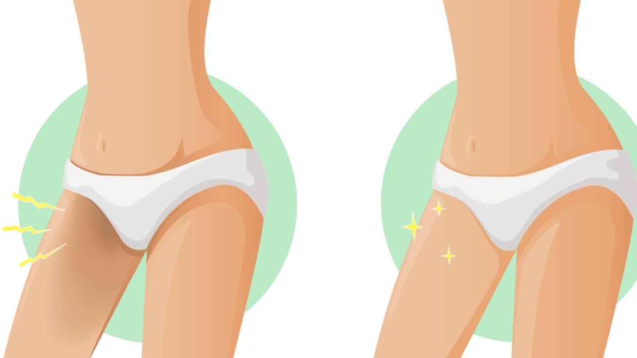 clareamento de virilha