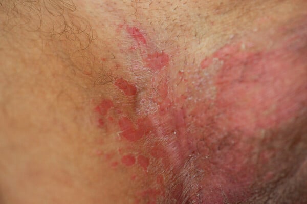 como acabar com a candidíase definitivamente