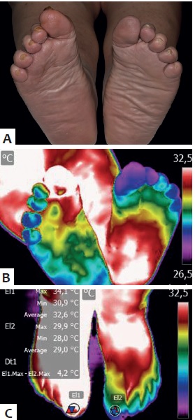 5 dicas essenciais para cuidar dos pés diabéticos