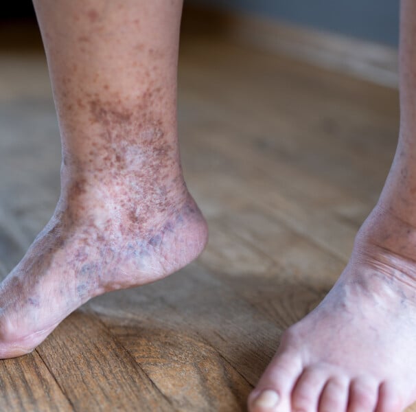 consequencias graves escalda pes para diabeticos