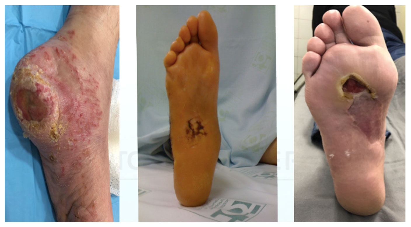 10 dicas essenciais para prevenir pé diabético