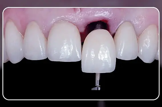 Dente Provisório vs. Definitivo: Entenda as Diferenças e Importância