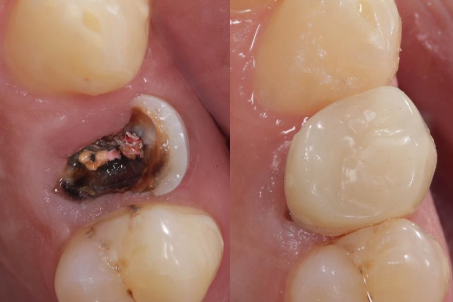 Como Cuidar do Dente Provisório para Evitar Problemas Futuros