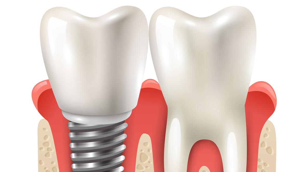 Dente Provisório vs. Definitivo: Entenda as Diferenças e Importância