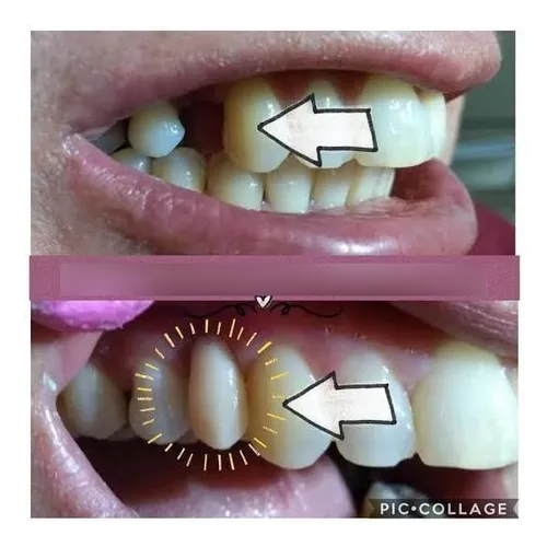 Alimentos Proibidos com Dente Provisório: Guia Completo