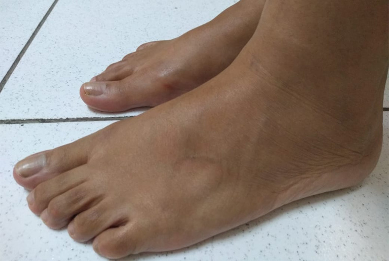 piores erros diabéticos pés