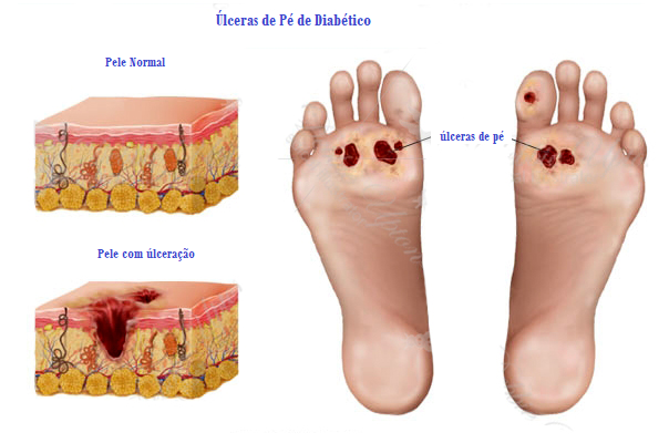 piores erros cuidado pés diabéticos evitar