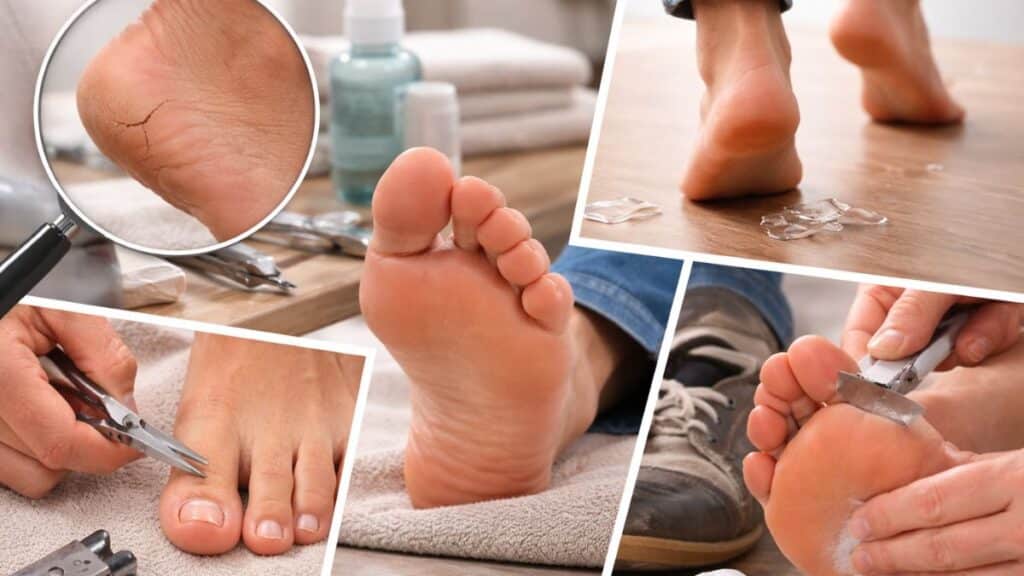 principais erros escalda pés diabetes