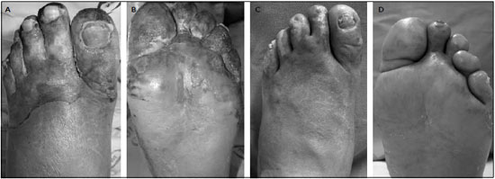 alternativas seguras escalda pes diabetes