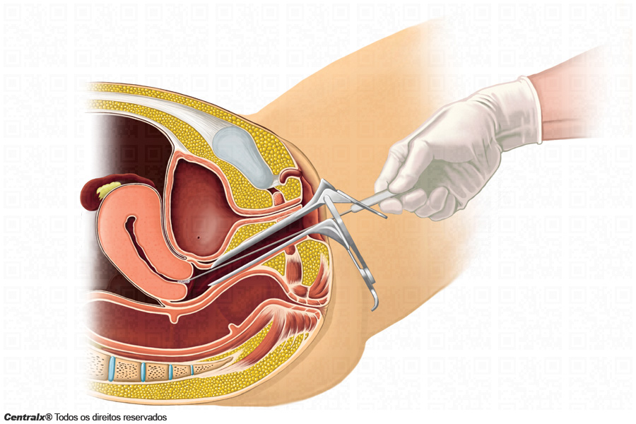 exame papanicolau o que é e para que serve