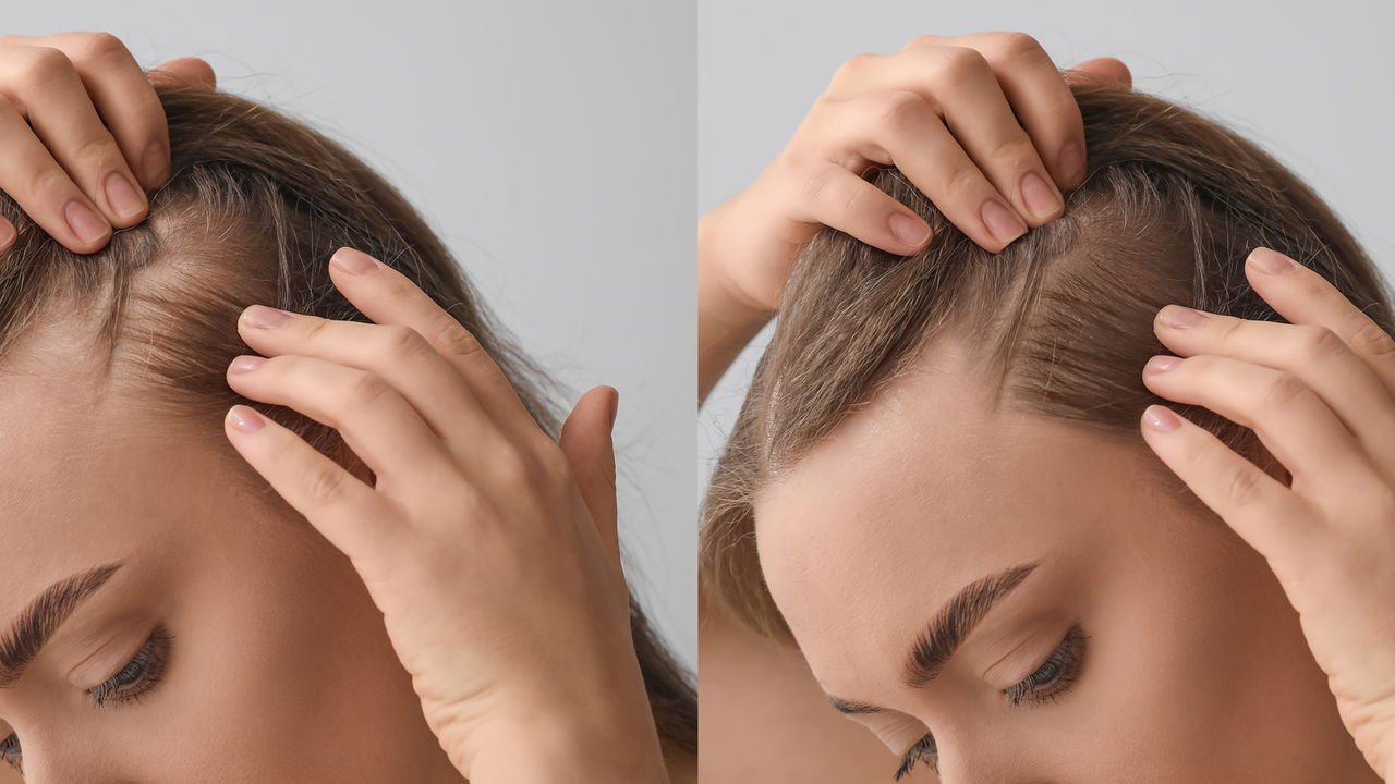 As Melhores Vitaminas e Suplementos para o Crescimento Saudável do Cabelo