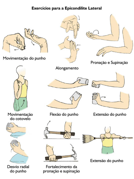 Guia Completo: Exercícios para Aliviar a Dor do Cotovelo de Tenista
