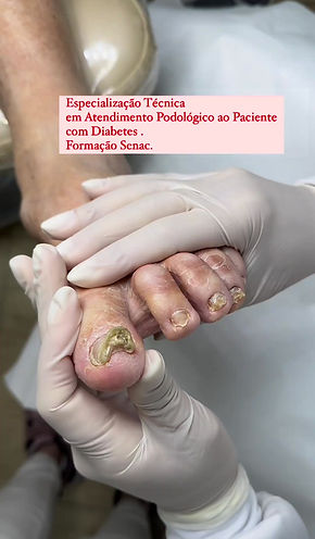 como usar espelho inspecionar planta pe diabetico