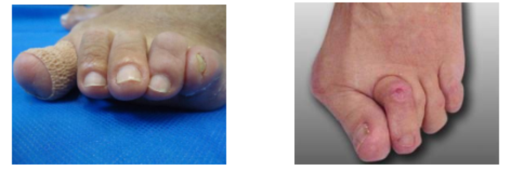 erros comuns no manejo da neuropatia diabética nos pés