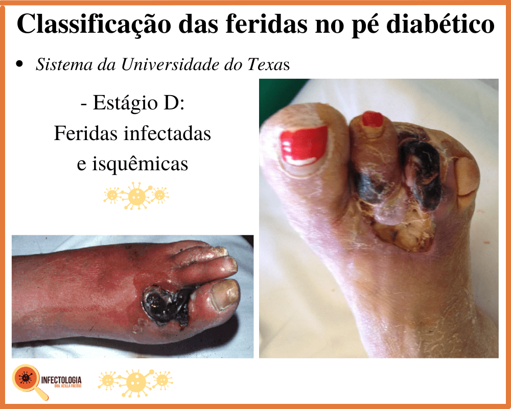 5 dicas essenciais para cuidar dos pés diabéticos com segurança