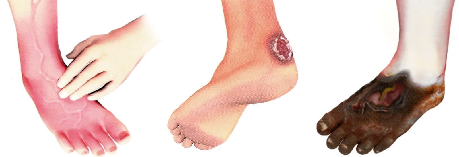 os 7 erros fatais do escalda pés para quem tem diabetes