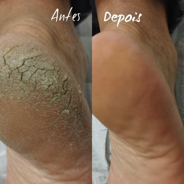 para tirar rachaduras do pé