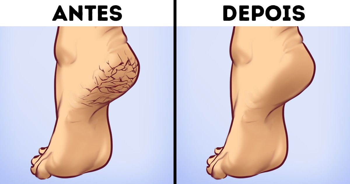 para tirar rachaduras do pé