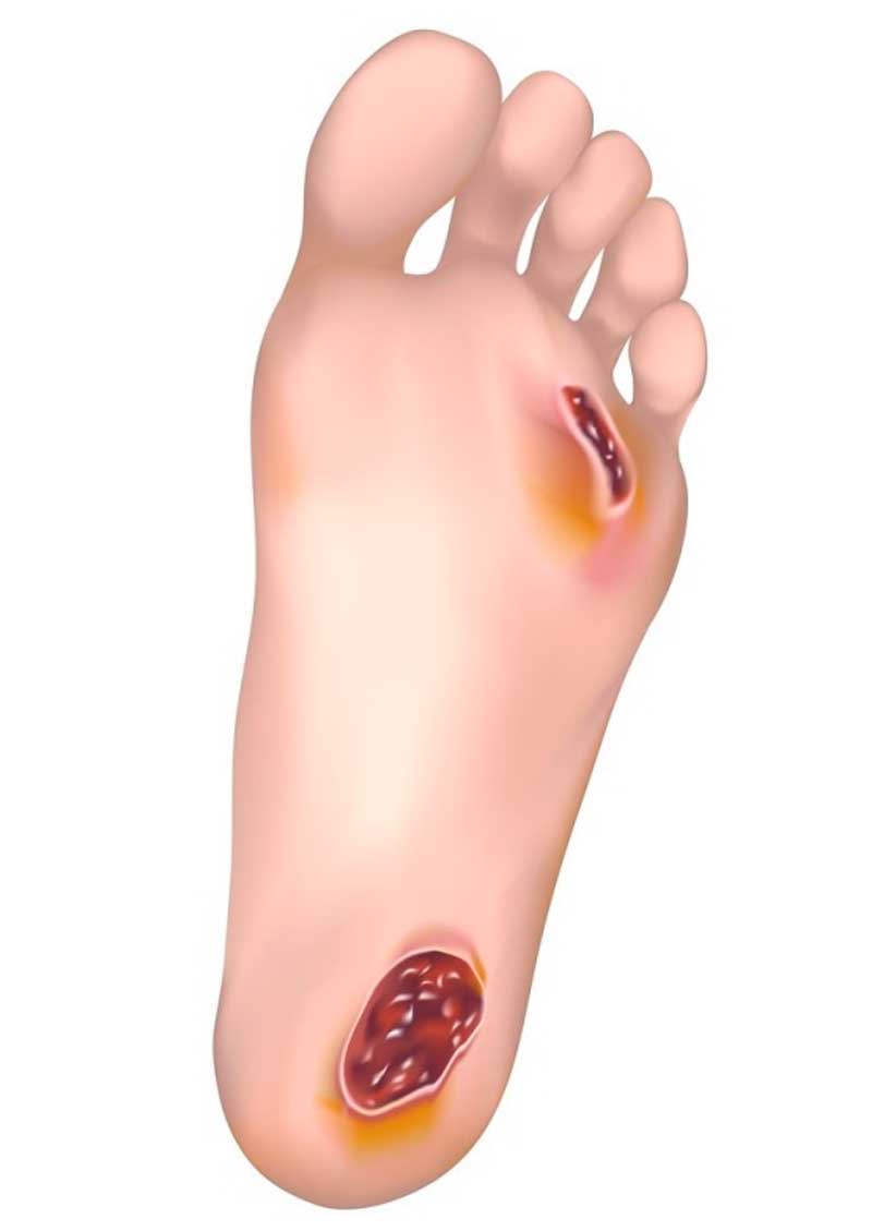 como cuidar do pé diabético para evitar problemas