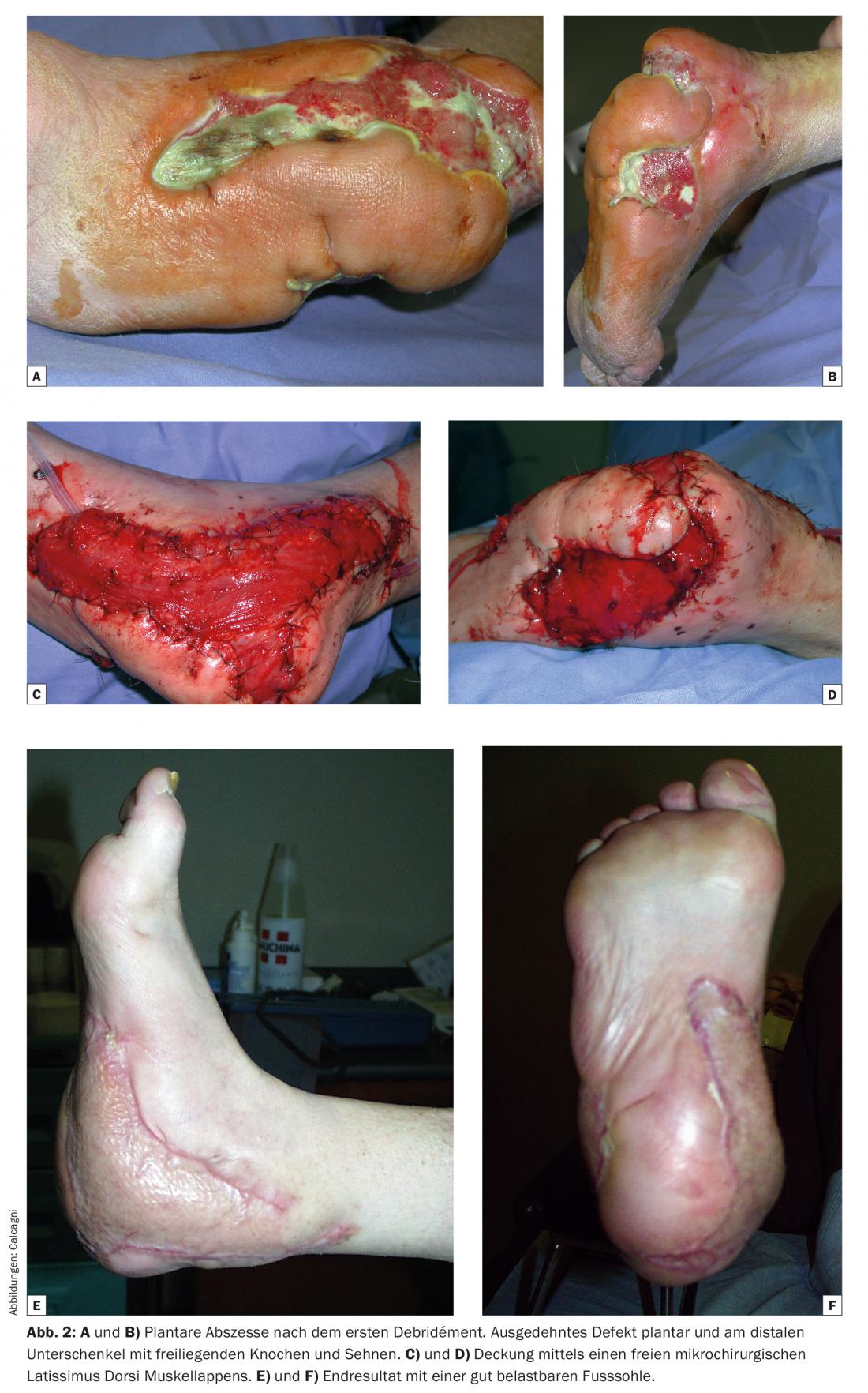 quanto custa o tratamento de um pé diabético infectado