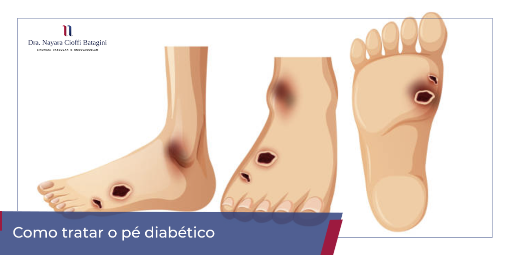 erros comuns no tratamento pé diabético