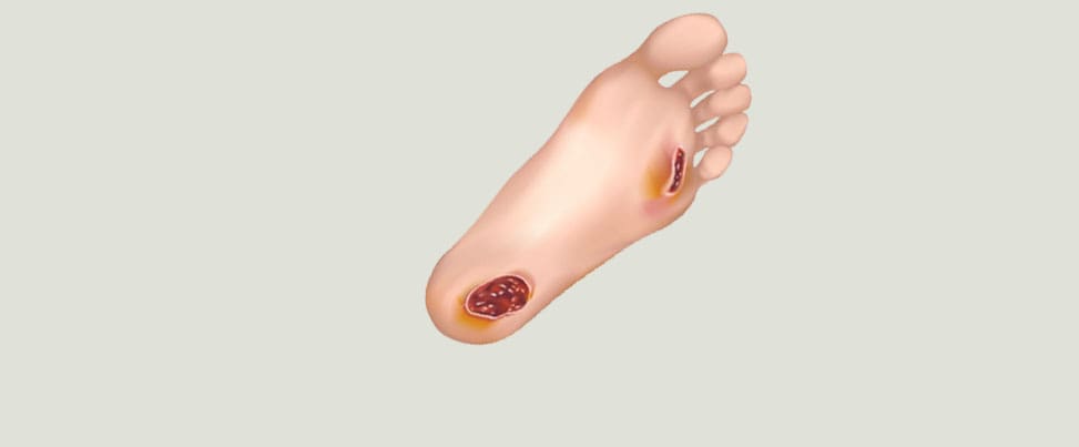 quanto custa tratar queimadura pe diabetico