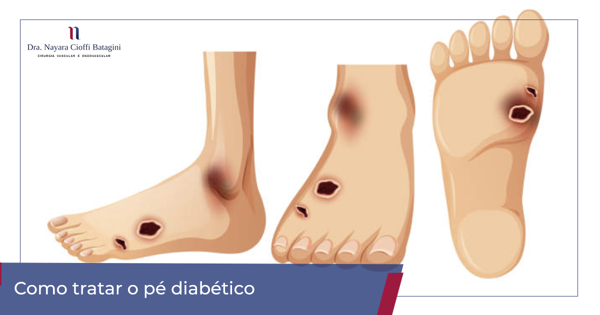 7 dicas essenciais para evitar queimaduras no pé diabético