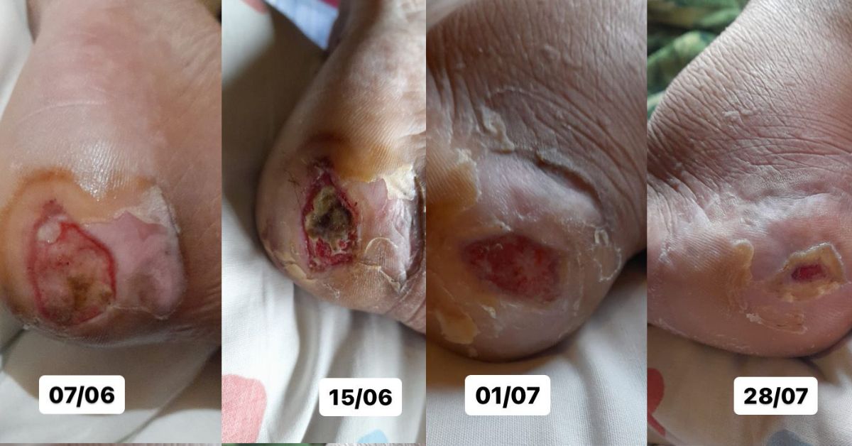os maiores erros no tratamento de queimadura em pé diabético