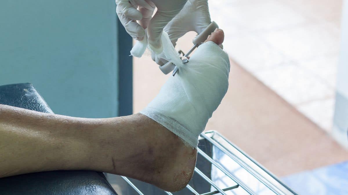 распространённые ошибки в лечении диабетической стопы, приводящие к ампутации