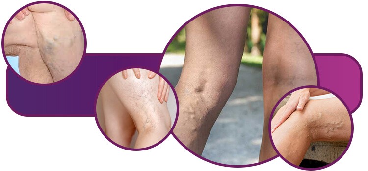 tratamento de varizes