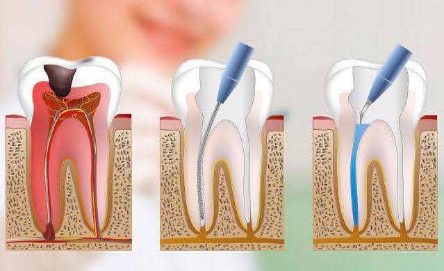 erros comuns no tratamento de canal que você deve evitar