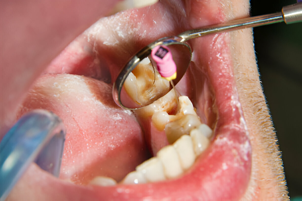 O que é endodontia e quando é necessária?