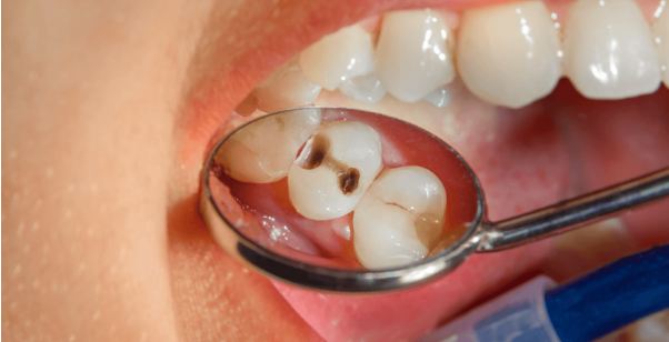 O que é endodontia e quando é necessária?